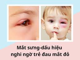 TUYÊN TRUYỀN BỆNH ĐAU MẮT ĐỎ CHO TRẺ